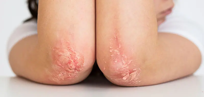 calmer les peaux fragilisées par le psoriasis