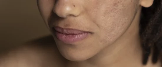 Imperfections du visage. Leur dire adieu avec un savon d’Alep