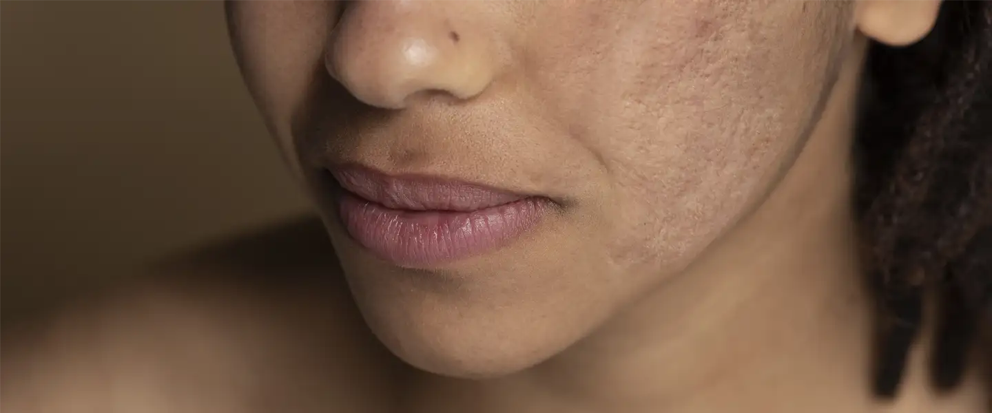 Imperfections du visage